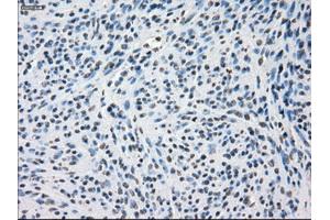 Immunohistochemical staining of paraffin-embedded Adenocarcinoma of colon tissue using anti-SSX2mouse monoclonal antibody. (SSX2 抗体)