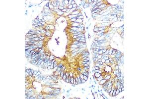 Immunohistochemistry of paraffin-embedded human colon carcinoma using Aquaporin-1 (Aquaporin-1 ) Rabbit mAb (ABIN1682901, ABIN3018679, ABIN3018680 and ABIN7101646) at dilution of 1:100 (40x lens). (Aquaporin 1 抗体)