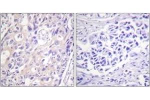 Immunohistochemistry analysis of paraffin-embedded human breast carcinoma, using p90 RSK (Phospho-Thr359+Ser363) Antibody. (RPS6KA3 抗体  (pThr359))