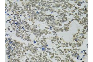 Immunohistochemistry of paraffin-embedded human lung cancer using PPP4C antibody (ABIN5971135) at dilution of 1/100 (40x lens). (PPP4C 抗体)