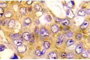 Immunohistochemistry (IHC) analyzes of BAD antibody in paraffin-embedded human breast carcinoma tissue. (BAD 抗体)
