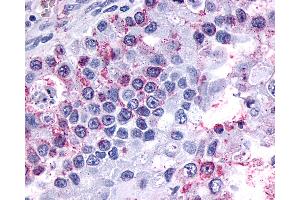 Anti-GPR3 antibody IHC of human Ovary, Carcinoma.
