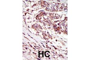 Formalin-fixed and paraffin-embedded human hepatocellular carcinoma tissue reacted with CAMK1G polyclonal antibody  , which was peroxidase-conjugated to the secondary antibody, followed by AEC staining. (CAMK1G 抗体  (C-Term))