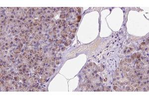 ABIN6273238 at 1/100 staining Human pancreas cancer tissue by IHC-P. (ETFA 抗体  (Internal Region))