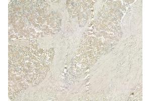 ABIN6258492 and ABIN6274927 at 1/100 staining human prostate carcinoma by IHC-P. (BCAS4 抗体  (Internal Region))