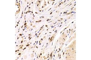 Immunohistochemistry of paraffin-embedded Human gastric cancer using PPP1R8 antibody at dilution of 1:100 (x400 lens). (PPP1R8 抗体)