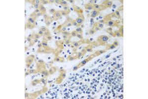 Immunohistochemistry of paraffin-embedded human liver cancer using SHBG antibody (ABIN5975291) at dilution of 1/100 (40x lens). (SHBG 抗体)