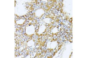 Immunohistochemistry of paraffin-embedded human colon carcinoma using MT-CO3 antibody (ABIN7266636) at dilution of 1:100 (40x lens). (COX3 抗体)