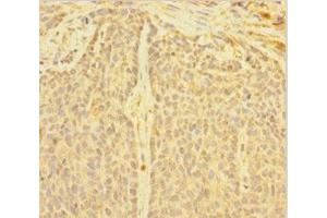 Immunohistochemistry of paraffin-embedded human ovarian cancer using ABIN7149718 at dilution of 1:100 (DNTTIP1 抗体  (AA 1-329))