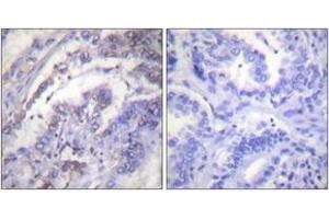 Immunohistochemistry analysis of paraffin-embedded human lung carcinoma tissue, using Histone H3 (Ab-3) Antibody. (Histone 3 抗体  (AA 1-50))