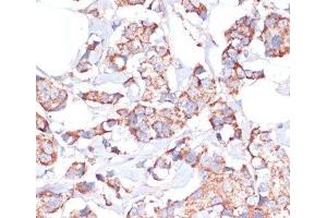 Immunohistochemistry of paraffin-embedded Human breast cancer using UBE2O Polyclonal Antibody at dilution of 1:100 (40x lens). (UBE2O 抗体)
