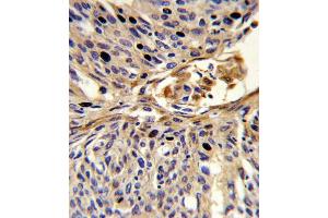 Formalin-fixed and paraffin-embedded human lung carcinoma reacted with EX2 Antibody (Center), which was peroxidase-conjugated to the secondary antibody, followed by DAB staining. (APEX2 抗体  (AA 143-171))