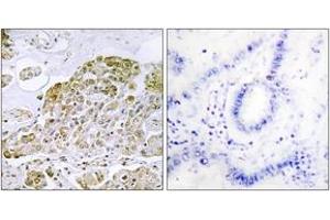 Immunohistochemistry analysis of paraffin-embedded human lung carcinoma tissue, using TFEB Antibody. (TFEB 抗体  (AA 10-59))