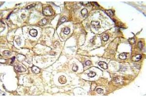 Immunohistochemistry (IHC) analyzes of p-ERK1/2 antibody in paraffin-embedded human breast carcinoma tissue. (ERK1 抗体  (pThr202, pTyr204))