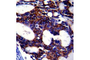 Paraformaldehyde-fixed, paraffin embedded human breast carcinoma, Antigen retrieval by boiling in sodium citrate buffer (pH6. (TGFB2 抗体)