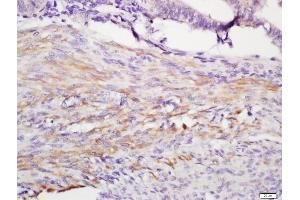 Formalin-fixed and paraffin embedded human endometrium labeled with Anti-IGFBP1 Polyclonal Antibody, Unconjugated (ABIN734948) at 1:200 followed by conjugation to the secondary antibody and DAB staining (IGFBPI 抗体  (AA 150-250))
