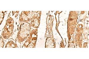Immunohistochemistry of paraffin-embedded Human liver cancer tissue using WDR33 Polyclonal Antibody at dilution of 1:65(x200) (WDR33 抗体)