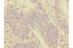 Immunohistochemistry of paraffin-embedded human colon cancer using ABIN7159959 at dilution of 1:100 (PMPCA 抗体  (AA 456-525))