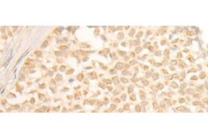 Immunohistochemistry of paraffin-embedded Human ovarian cancer tissue using CYP4X1 Polyclonal Antibody at dilution of 1:40(x200) (CYP4X1 抗体)