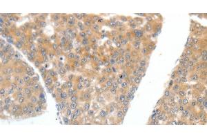 Immunohistochemistry of paraffin-embedded Human liver cancer tissue using FSHR Polyclonal Antibody at dilution 1:70 (FSHR 抗体)