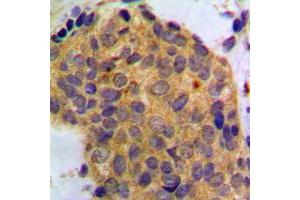 Immunohistochemical analysis of WNT1 staining in human breast cancer formalin fixed paraffin embedded tissue section.