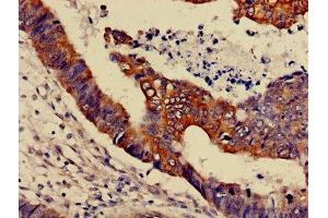 IHC image of ABIN7159999 diluted at 1:600 and staining in paraffin-embedded human colon cancer performed on a Leica BondTM system.