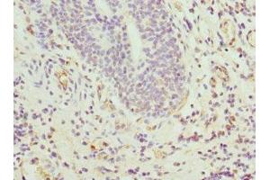 Immunohistochemistry of paraffin-embedded human bladder cancer using ABIN7144067 at dilution of 1:100 (CIAPIN1 抗体  (AA 1-312))