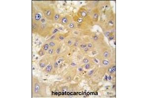 Formalin-fixed and paraffin-embedded human hepatocarcinoma tissue reacted with L antibody (N-term) (ABIN391461 and ABIN2841436) , which was peroxidase-conjugated to the secondary antibody, followed by DAB staining. (LAP3 抗体  (N-Term))