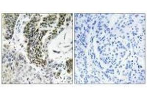 Immunohistochemistry analysis of paraffin-embedded human lung carcinoma tissue using RREB1 antibody. (RREB1 抗体)