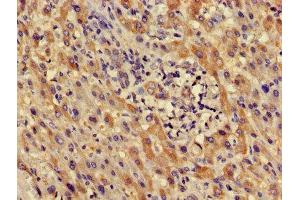 Immunohistochemistry of paraffin-embedded human liver cancer using ABIN7164407 at dilution of 1:100 (LDHD 抗体  (AA 310-507))