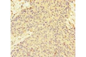 Immunohistochemistry of paraffin-embedded human ovarian cancer using ABIN7165791 at dilution of 1:100 (MAGOH 抗体  (AA 1-146))