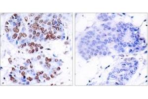 Immunohistochemistry analysis of paraffin-embedded human breast carcinoma tissue, using NF-kappaB p65 (Ab-276) Antibody. (NF-kB p65 抗体  (AA 249-298))