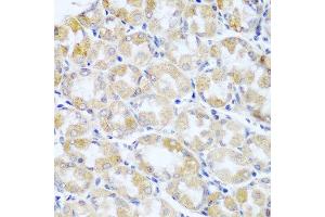 Immunohistochemistry of paraffin-embedded human stomach cancer using ANKRD52 antibody at dilution of 1:100 (40x lens). (ANKRD52 抗体)