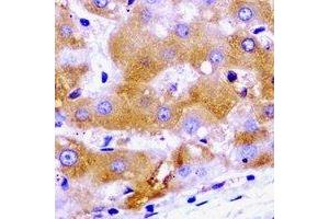Immunohistochemical analysis of SCYL1 staining in human liver cancer formalin fixed paraffin embedded tissue section. (SCYL1 抗体)