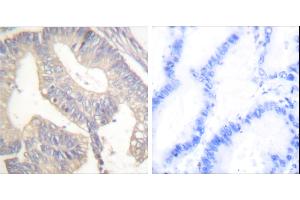 Peptide - +Immunohistochemical analysis of paraffin-embedded human colon carcinoma tissue using Gastrin antibody (#C0205). (Gastrin 抗体)