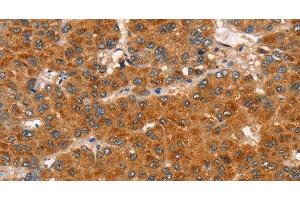 Immunohistochemistry of paraffin-embedded Human liver cancer tissue using RASA3 Polyclonal Antibody at dilution 1:35 (RASA3 抗体)