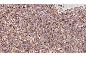ABIN6273183 at 1/100 staining Human lymph cancer tissue by IHC-P. (UQCRC2 抗体  (Internal Region))