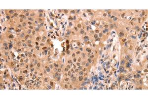 Immunohistochemistry of paraffin-embedded Human lung cancer using ACO2 Polyclonal Antibody at dilution of 1:30 (ACO2 抗体)
