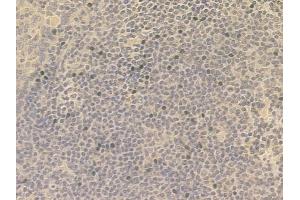 ABIN6258358 and ABIN6274562 at 1/100 staining human tongue carcinoma by IHC-P.