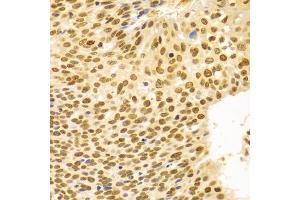 Immunohistochemistry of paraffin-embedded human esophageal cancer using DKC1 Antibody (ABIN5970956) at dilution of 1/100 (40x lens). (DKC1 抗体)