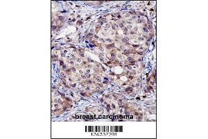 RNF144A Antibody immunohistochemistry analysis in formalin fixed and paraffin embedded human breast carcinoma followed by peroxidase conjugation of the secondary antibody and DAB staining. (RNF144A 抗体  (AA 156-184))