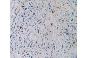 IHC-P analysis of Human Stomach Cancer Tissue, with DAB staining. (TPSAB1 抗体  (AA 161-262))