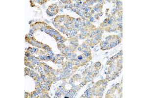 Immunohistochemistry of paraffin-embedded human liver cancer using ATPIF1 antibody. (ATPase Inhibitory Factor 1 抗体  (AA 26-106))