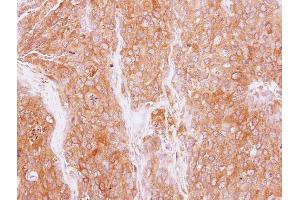 IHC-P Image Immunohistochemical analysis of paraffin-embedded BT474 xenograft, using GMF beta, antibody at 1:500 dilution. (GMFB 抗体)