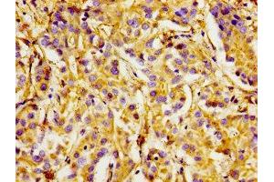 Immunohistochemistry of paraffin-embedded human liver cancer using ABIN7156425 at dilution of 1:100 (Integrin alpha 1 抗体  (AA 242-524))