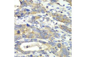 Immunohistochemistry of paraffin-embedded human gastric cancer using CHMP2B antibody. (CHMP2B 抗体)