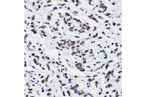 Immunohistochemistry of paraffin-embedded human gastric cancer using H3K18ac antibody (ABIN7267668) at dilution of 1:100 (40x lens).
