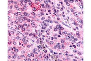 Anti-MRGPRX4 / MRGX4 antibody IHC of human Lung, Non-Small Cell Carcinoma. (MRGPRX4 抗体  (N-Term))