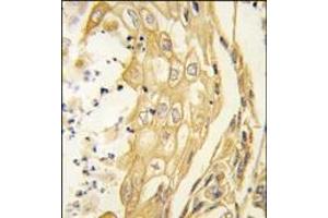 Formalin-fixed and paraffin-embedded human lung carcinoma tissue reacted with the EphB4 antibody, which was peroxidase-conjugated to the secondary antibody, followed by DAB staining. (EPH Receptor B4 抗体)