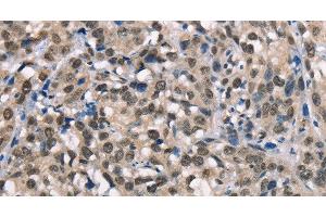 Immunohistochemistry of paraffin-embedded Human esophagus cancer using NSMCE3 Polyclonal Antibody at dilution of 1:40 (Necdin-Like 2 抗体)